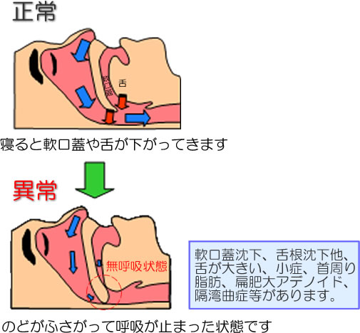 睡眠時無呼吸症候群の原因